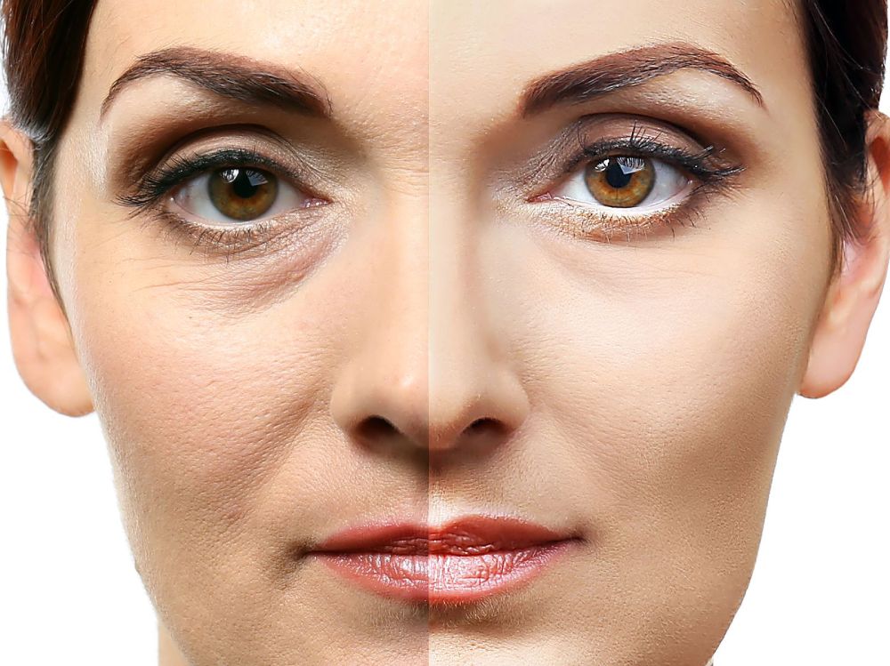 Blefaroplastia