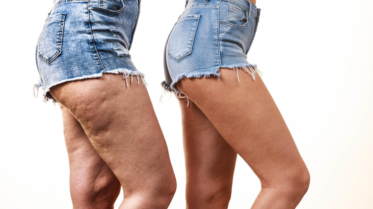 Celulitis