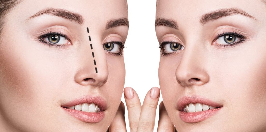 Rinoplastia