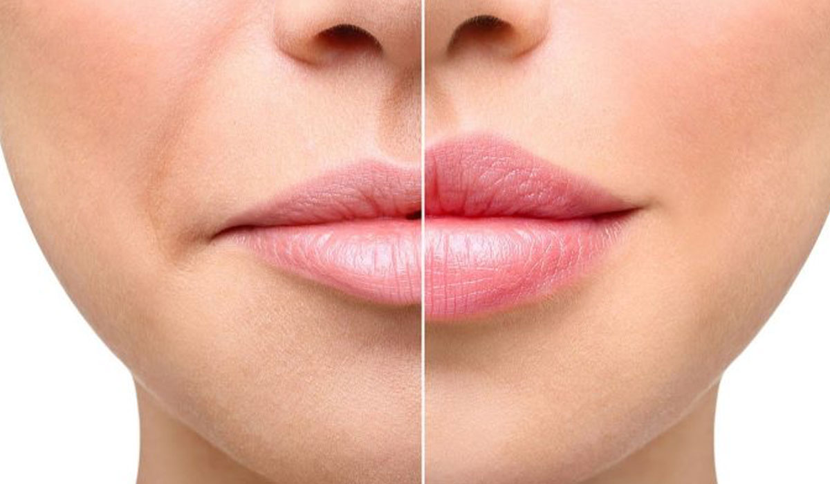 acido-hialuronico-y-el-relleno-de-labios
